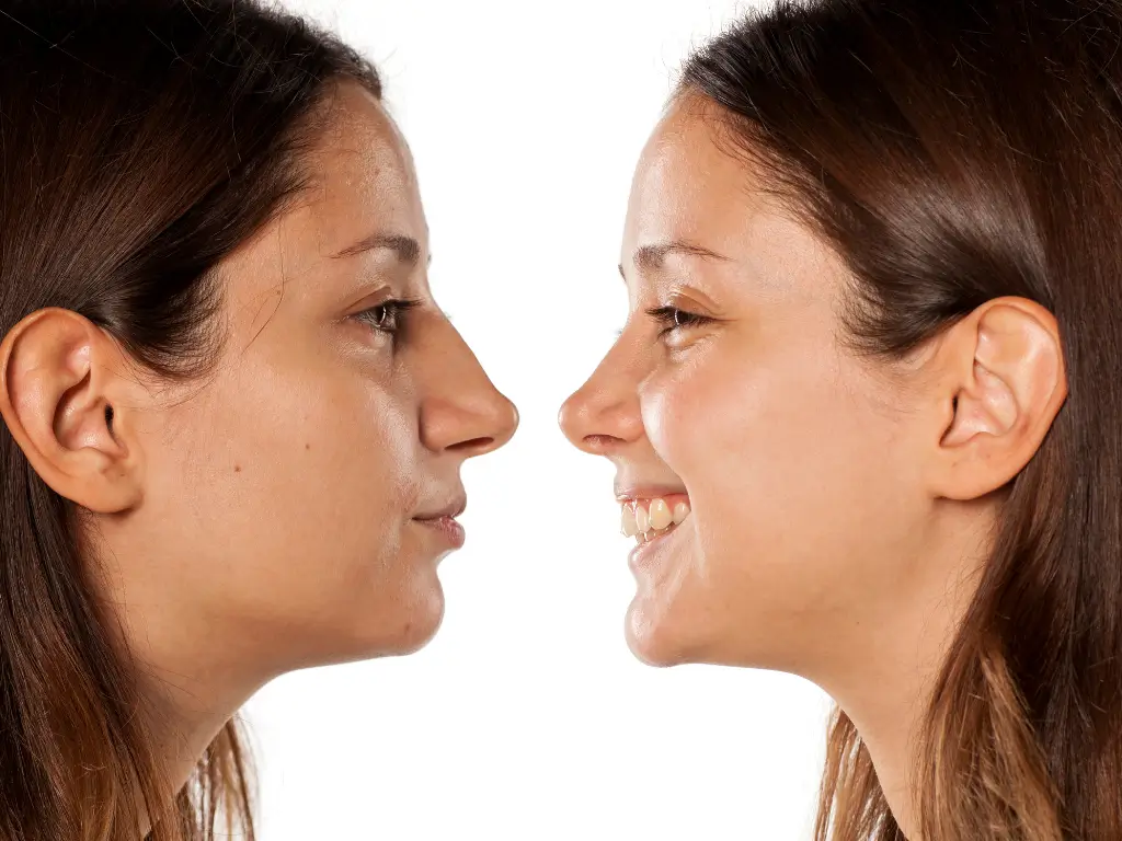 rhinoplasty before after seo