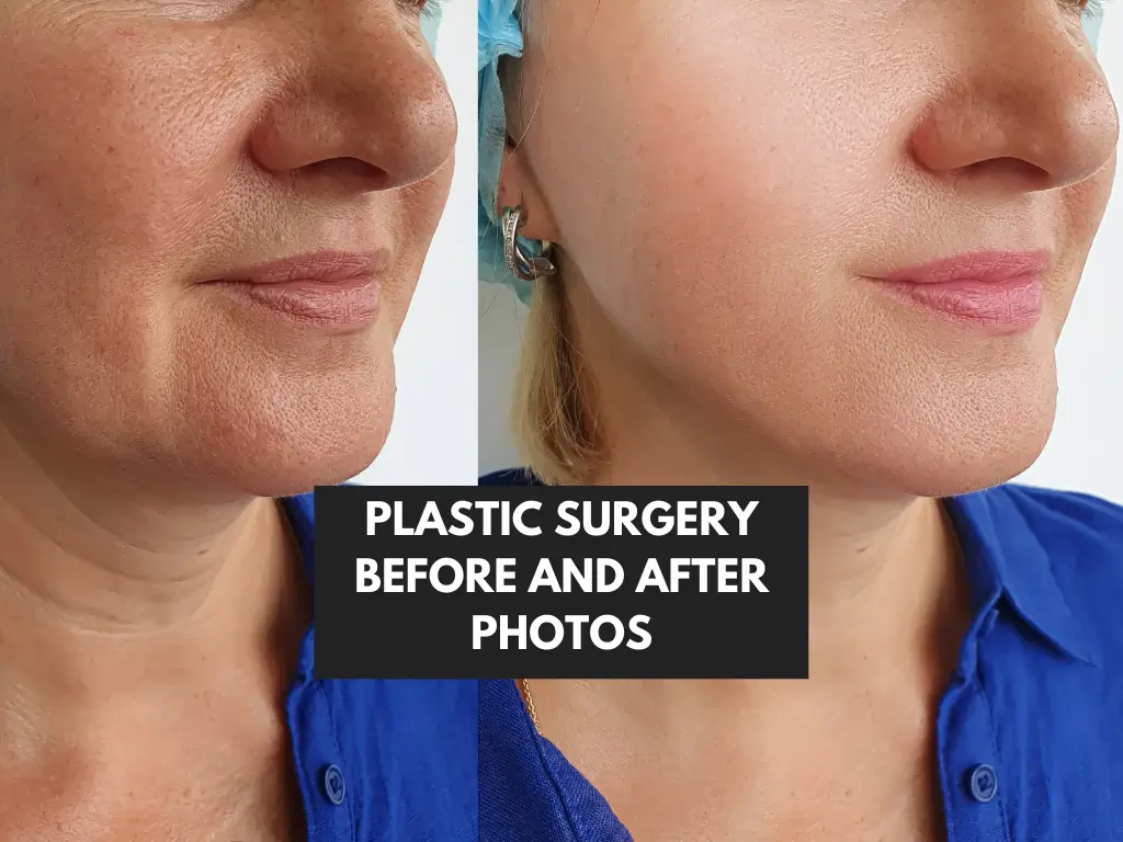 Plastic Surgery Before and After Photos